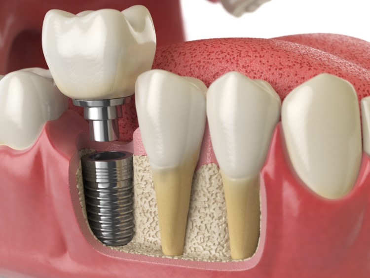 A diagram of a dental implant being installed into a jaw